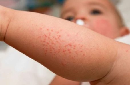 Тернополем шириться кір: медики закликають людей вакцинуватися