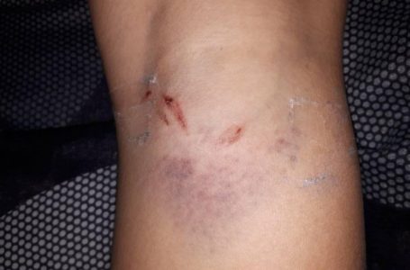 У Тернополі жінка з покусаною ногою 5 годин відловлювала собаку-кривдника